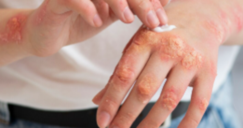 Homem com lesões de pele, refletindo dor e isolamento devido à Mpox