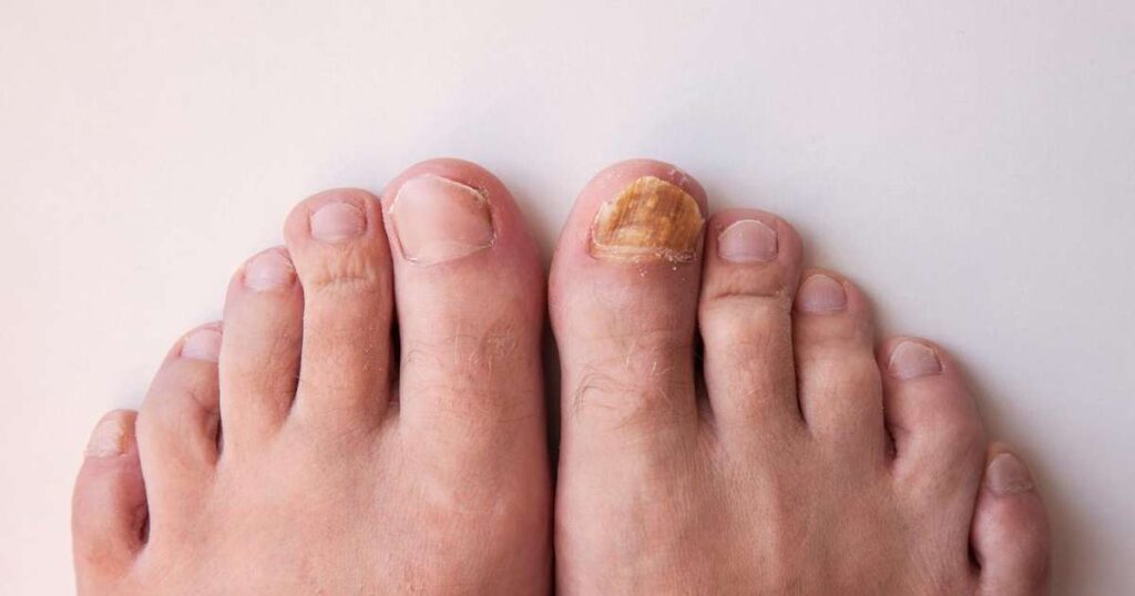 Unhas em diversas condições de saúde, mostrando variações de cor e textura.