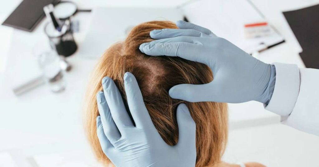 Imagem representativa de caspa no couro cabeludo, mostrando escamas visíveis e irritação.